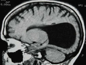 Nacen dos bebés sin globos oculares formados en el hospital Punta Europa