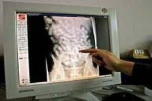 Detenida una persona con 400 gramos de hachís en el interior del cuerpo