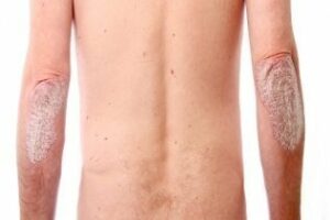 Consejos de Salud y belleza: Di adios a la Psoriasis, resultados garantizados
