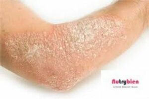 Salud C.G, Los consejos con descuentos de Nutribien: Psoriasis