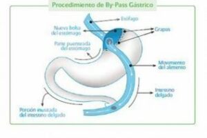 Un joven algecireño con un peso de casi 300 kilos perderá 200 kilos con una operación