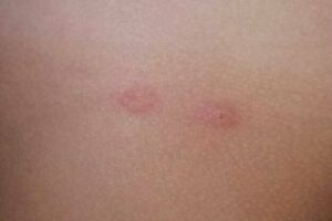 Aclaración del ayuntamiento ante las picaduras de insectos en centros escolares