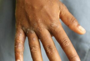 Acaip denuncia un aumento de casos de sarna en las cárceles españolas: de 58 a 176 en cinco años