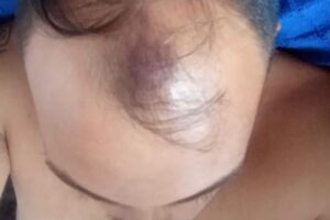 Herido un trabajador de la limpieza en San Roque al lanzarla un botellín desde una ventana